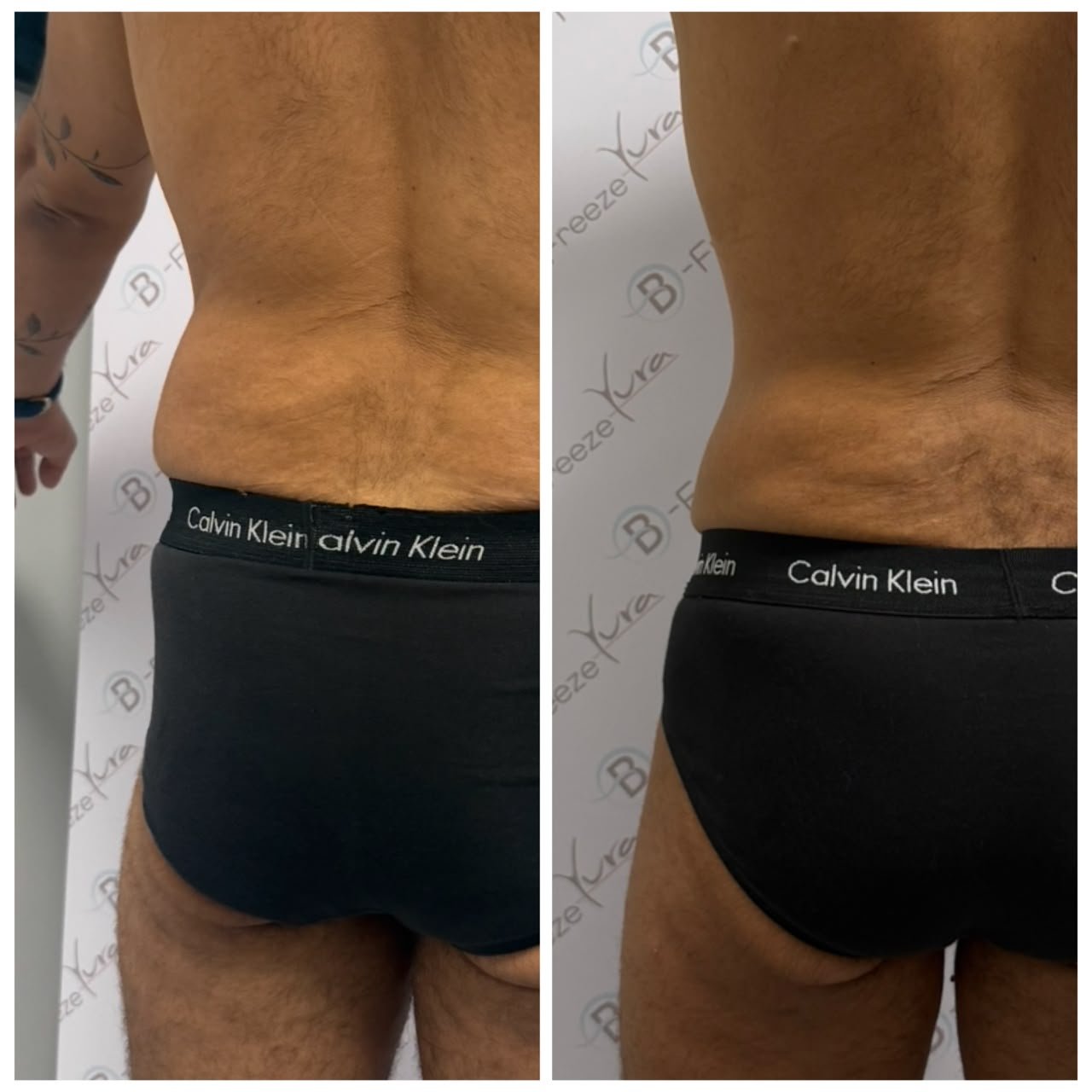Cryolipolyse & remodelage — avant/après