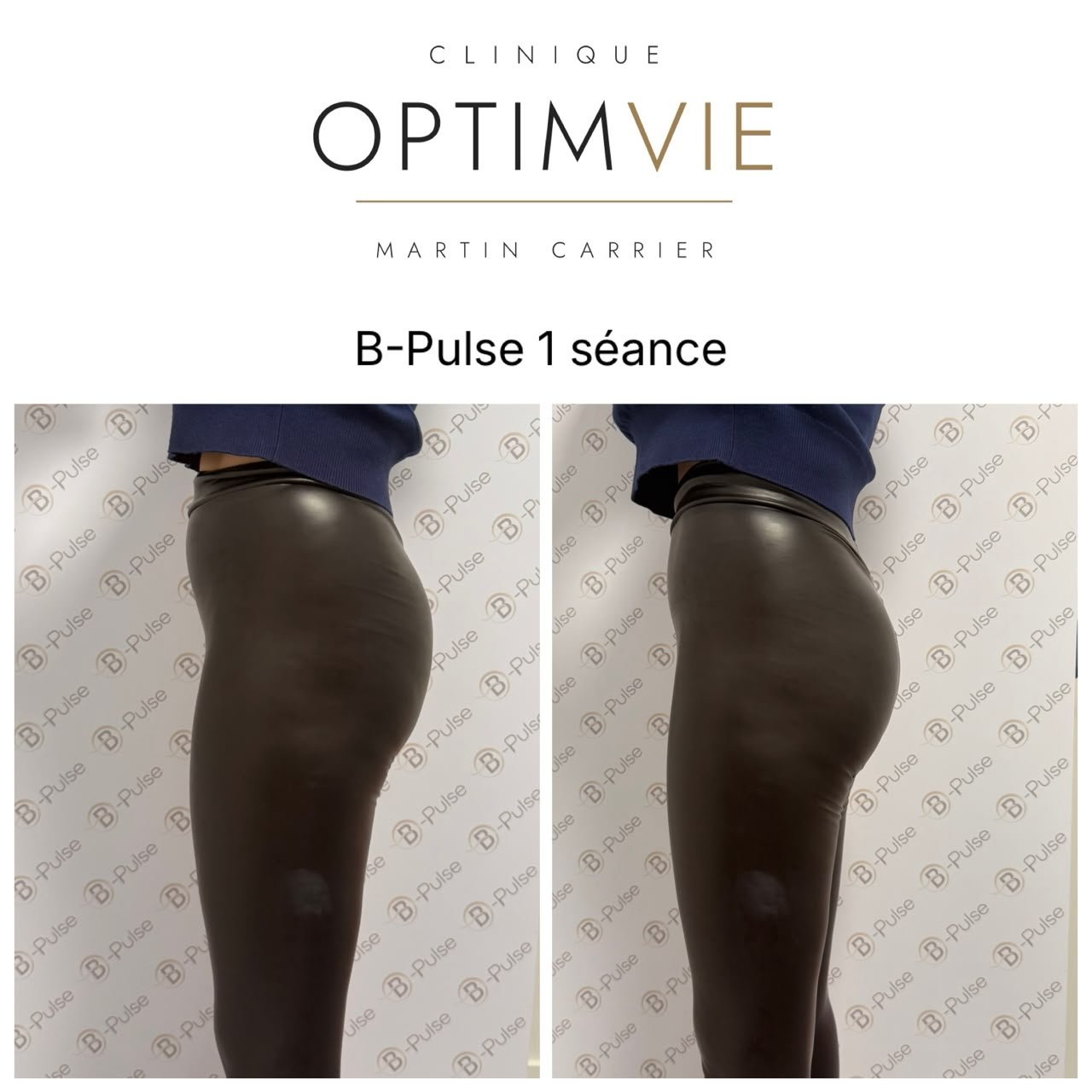 Avant/après B-Pulse — fessier après 1 séance