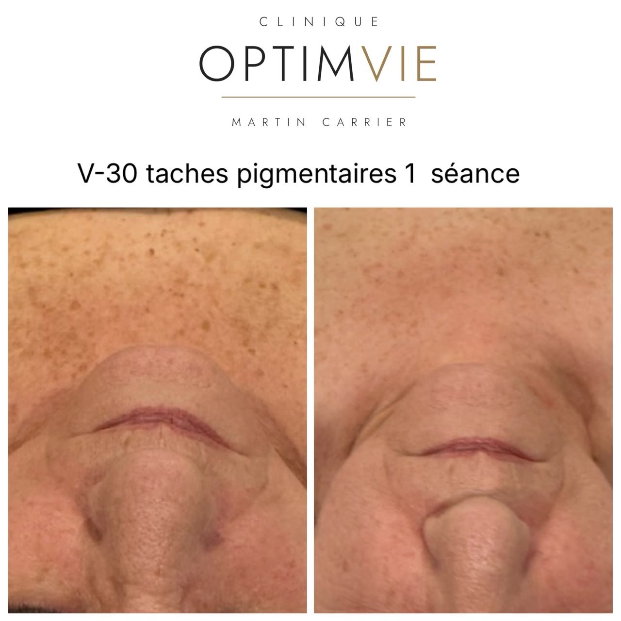 Avant/après V-30 — taches pigmentaires après 1 séance