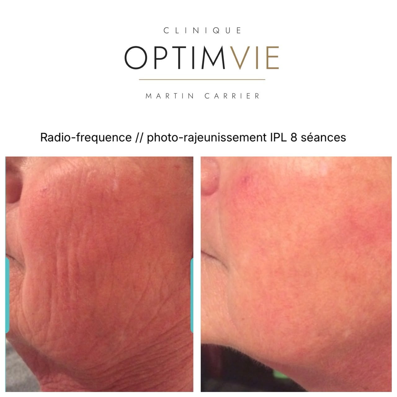 Avant/après radiofréquence et photo-rajeunissement IPL du visage après 8 séances