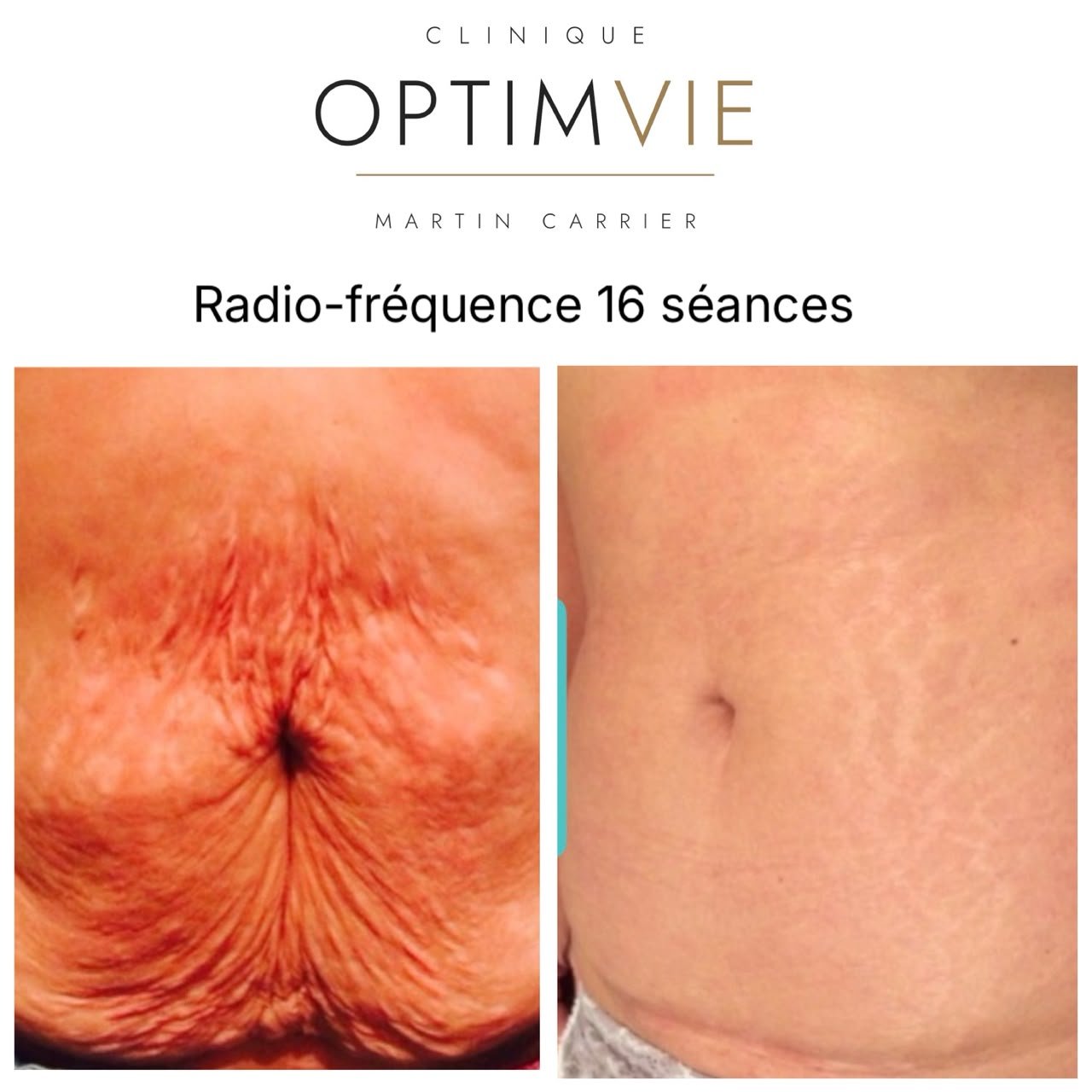 Avant/après radiofréquence — abdomen après 16 séances