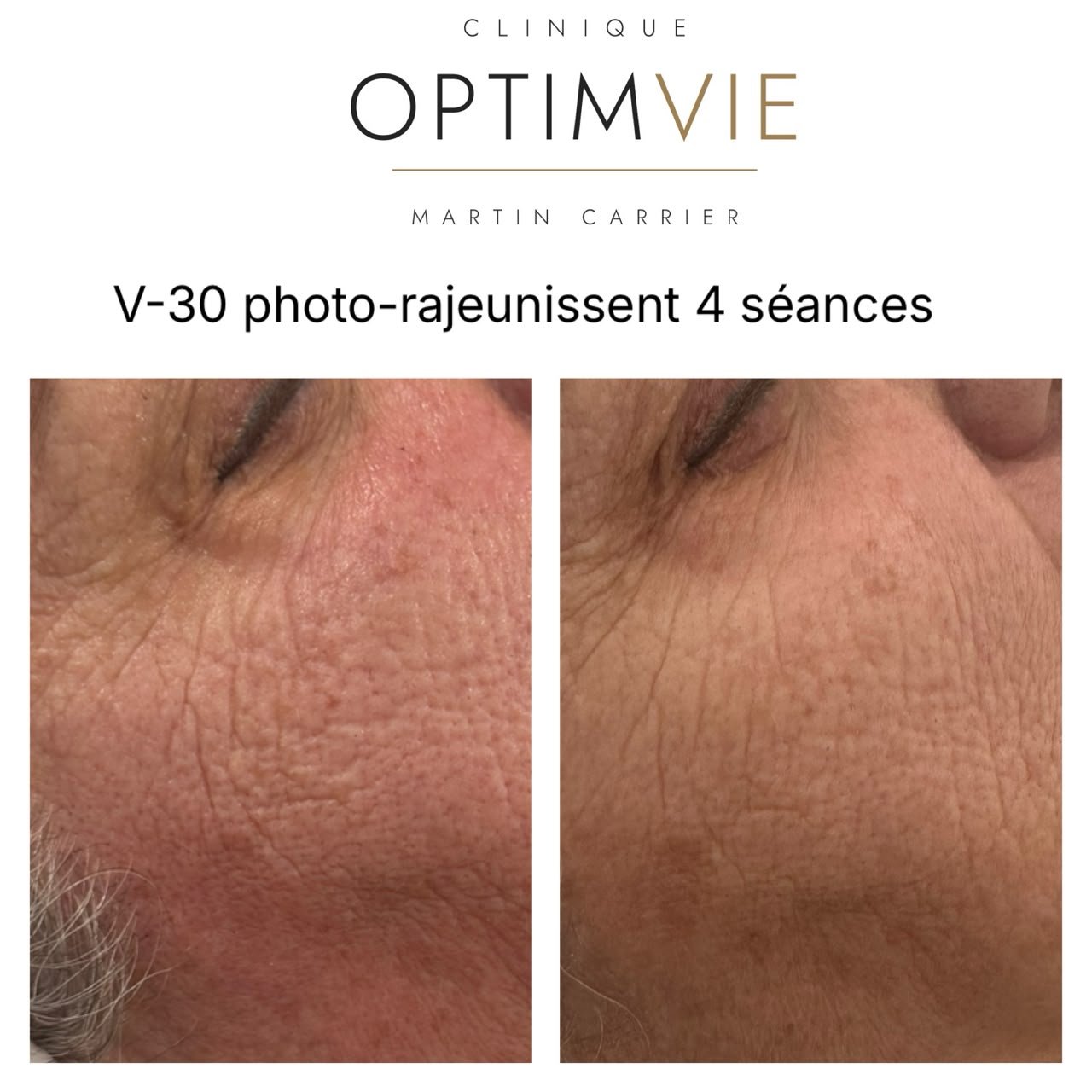 Avant/après V-30 photo-rajeunissement du visage après 4 séances