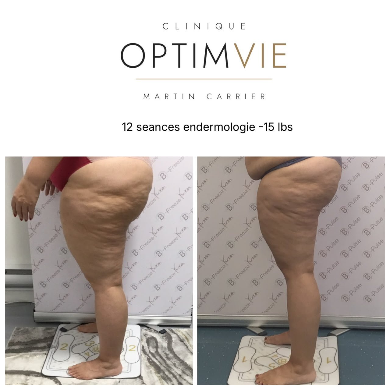 Avant/après endermologie — 12 séances, −15 lb