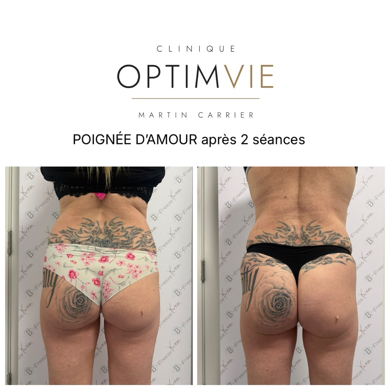 Avant/après B-Freeze — poignées d'amour après 2 séances