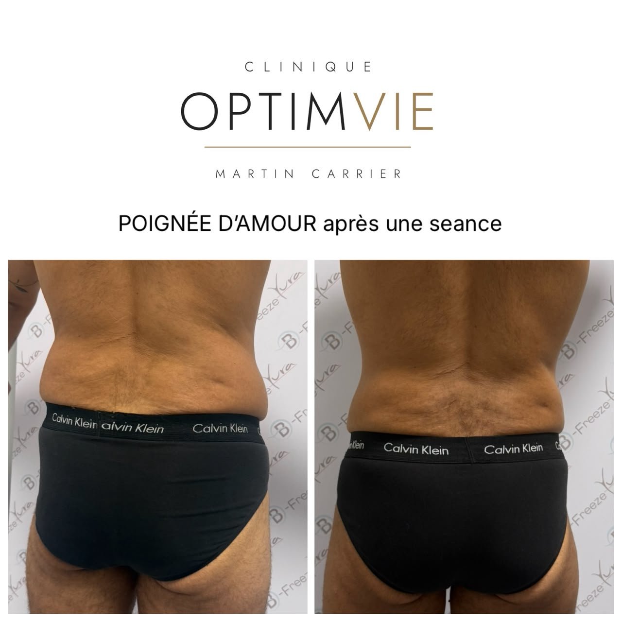Avant/après B-Freeze — poignées d'amour de dos après 1 séance